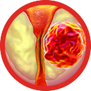 Adenoma prostata